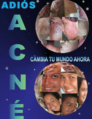 LIBRO EN PDF - Adiós Acné